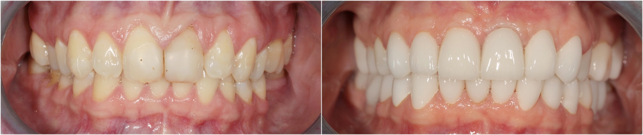 Sanierung der Mundhöhle. Implantatinstallation in den Kaubereich. Komplexe Prothetik mit Keramikveneeren.
