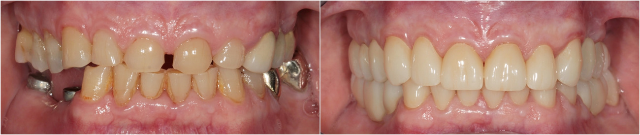 Implantation. Hygiene der Mundhöhle. Umfassende ästhetische Prothetik. Zirkonoxidkronen.