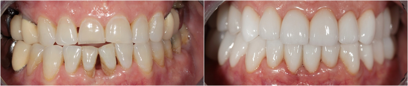 Komplexe Prothesen mit Keramikveneeren nach CEREC-Technologie im Frontalbereich. Zirkonoxidkronen und Brücken auf Kauzähne.