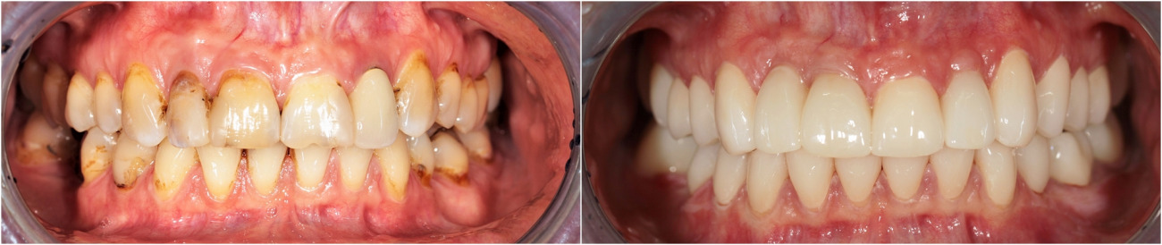 3D-Planung. Herstellung und Befestigung von Kronen und Veneers an allen Zähnen aus Zirkoniumdioxid.