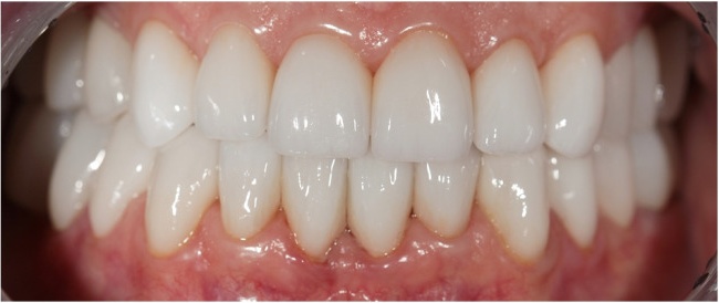 Komplexe Prothesen mit Keramikveneeren nach CEREC-Technologie im Frontalbereich. Zirkonoxidkronen und Brücken auf Kauzähne.