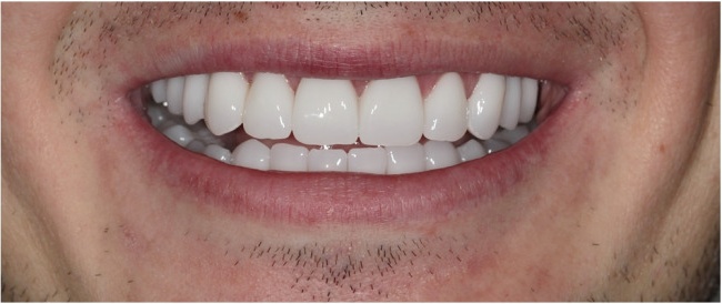 Installation von Implantaten. Ästhetische Prothetik mit Zirkonkronen BLEACH. Hollywood Smile.