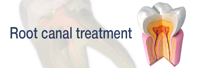 Root canal treatment