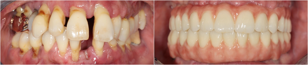 Extraction of teeth. 3D planning. Implantation of the 6 implants. Temporary prostheses on implants. Zirconium bridges with titan bar.