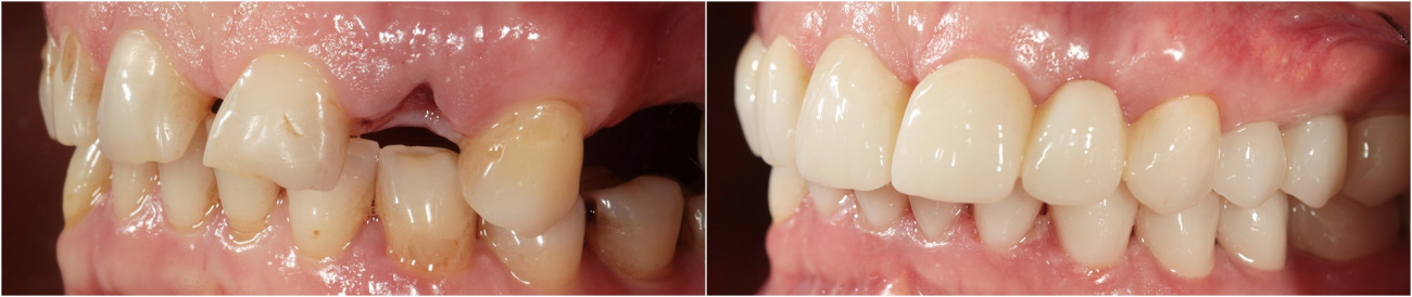 Esthetic prosthetic. Installation of implants. Zirconia bridges, ceramic crowns and veneers.