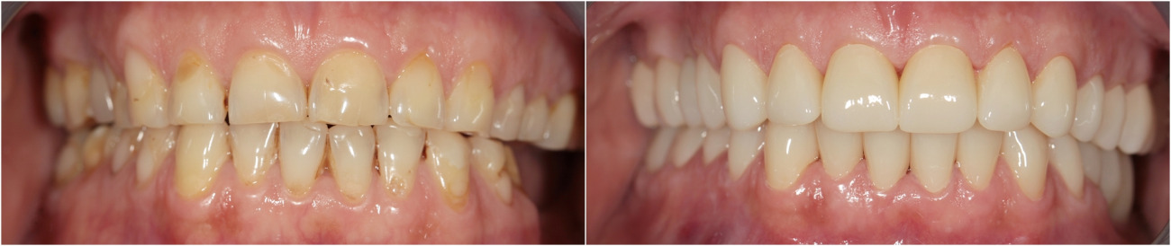 Complex esthetic prosthetic with full bite reconstruction. Zirconium crowns.