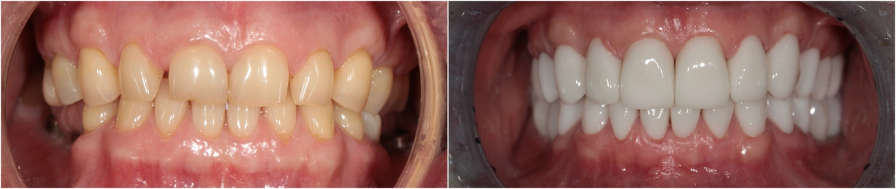 Full reconstruction upper jaw. Removing old crowns. Implantation. Zirconium crowns and bridges.