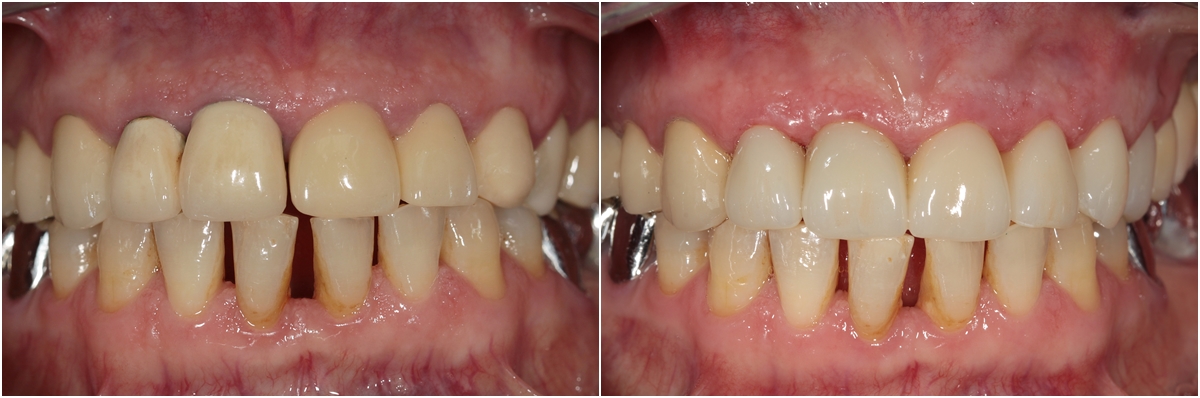 Changing old metal crowns on the zirconium crowns.