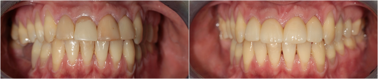 Dental hygiene. Endodontic retreatment. Build up of teeth. Changing of old fillings. Zirconium crowns.