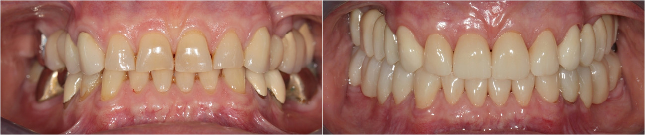 Complex prothetic of teeth. Full Bite Reconstruction. Zirconium crowns and bridges.