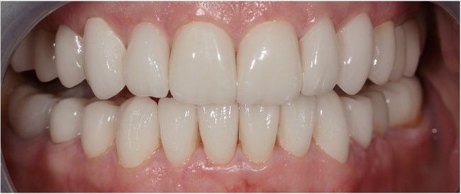 Complex prosthetic. Ceramic veneers. Ceramic crowns in the lateral areas.