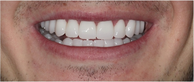 Installation of implants. Zirconium crowns BLEACH. Hollywood smile.
