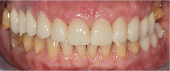 Fabrication and fixation the zirconium crowns and bridges on upper jaw.