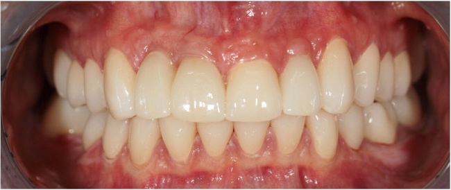 3D planning. Extraction of teeth. Immideate placement of implants. Zirconium crowns and veneers.