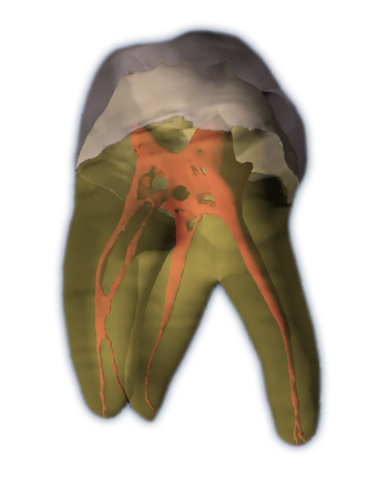 Root canal treatment