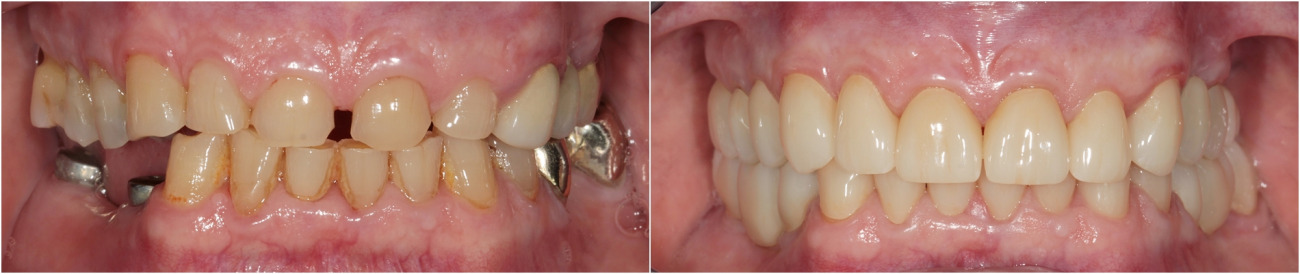 Имплантация зубов. Комплексное протезирование. Коронки из диоксида циркония.