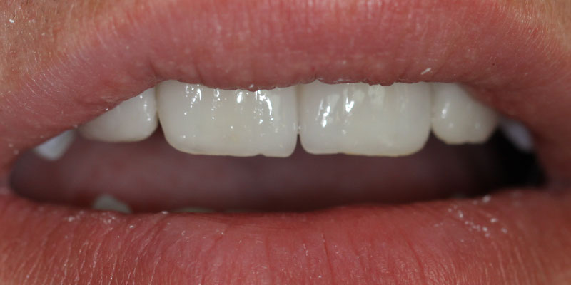 prosthesis by veneers