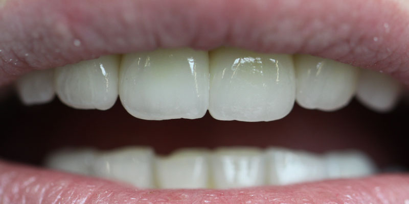 prosthesis by veneers