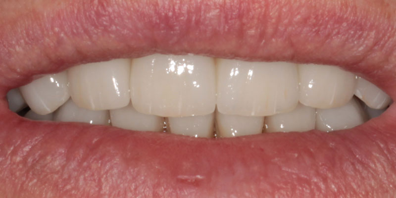 prosthesis by veneers