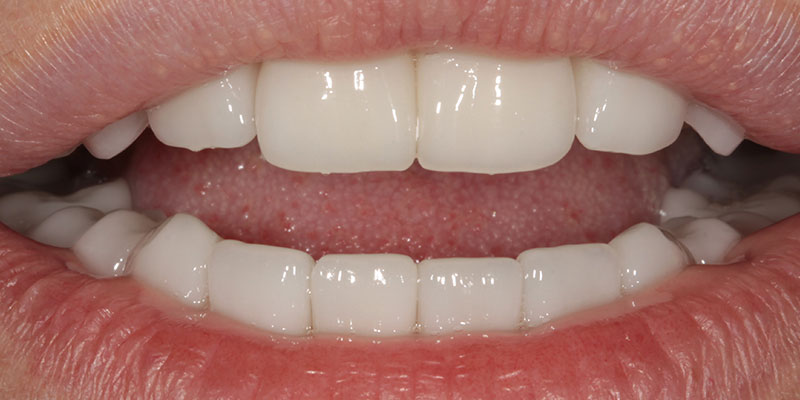 prosthesis by veneers