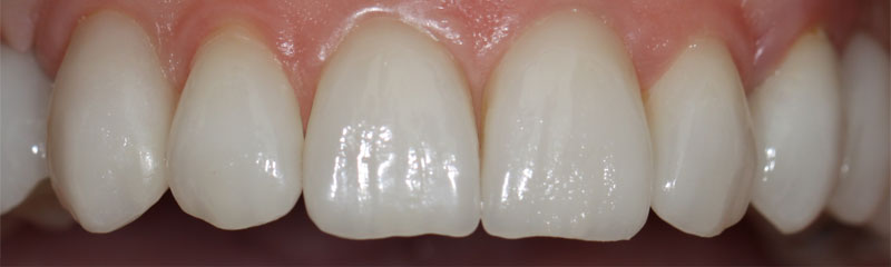 prosthesis by veneers