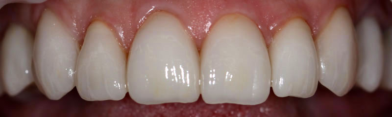 prosthesis by veneers