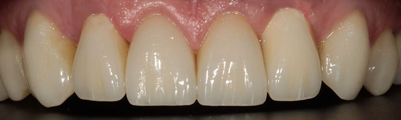 prosthesis by veneers