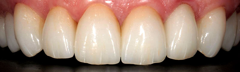 prosthesis by veneers