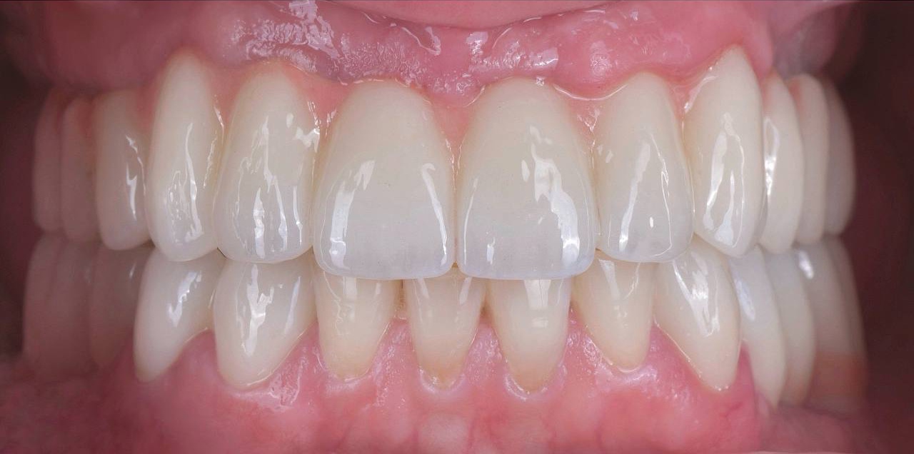Установка имплантов. Эстетическое протезирование коронками BLEACH. Hollywood smile.