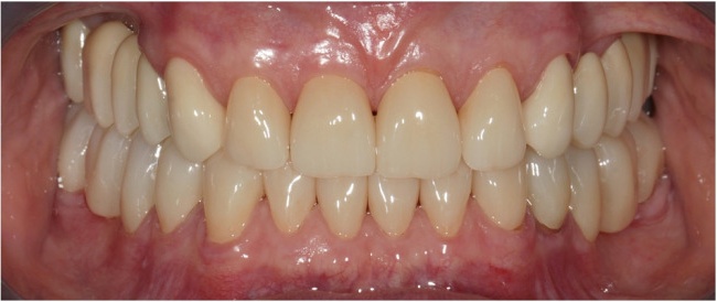 Комплексное протезирование зубов. Коронки и мосты из диоксида циркония.
